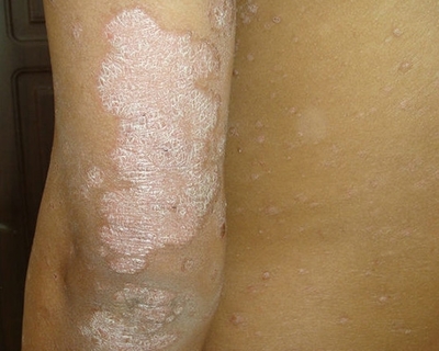 河南哪家醫(yī)院牛皮癬治的好?牛皮癬一定不能吃辣椒嗎?