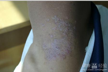 得了牛皮癬怎么辦？科學(xué)認(rèn)識(shí)與應(yīng)對(duì)之道