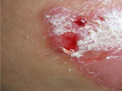 銀屑病（牛皮癬）的常見(jiàn)癥狀與識(shí)別